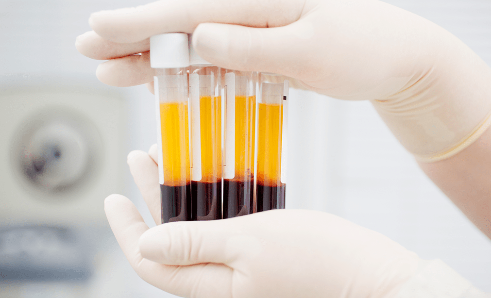 Plasma rico em plaquetas para terapia com PRP para artrose